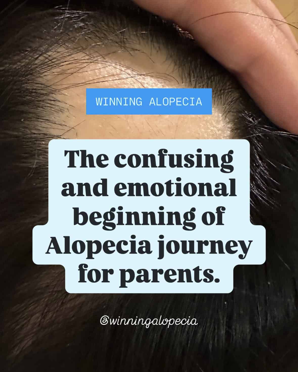 The beginning of alopecia journey for parents