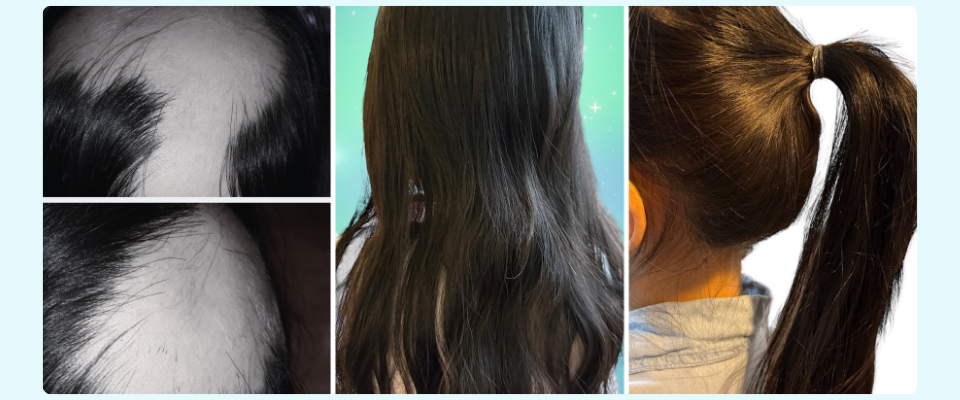 Win your life back with Winning Alopecia